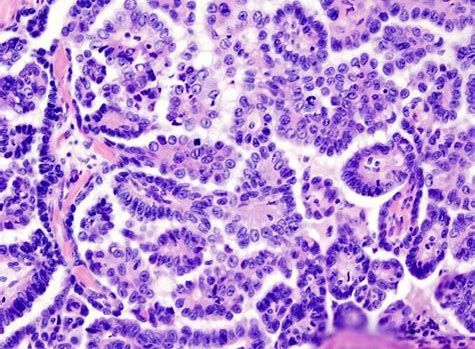 CancerRes：新研究发现帮助清除癌症干细胞的新靶标